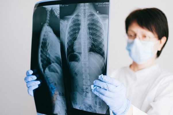 cbd-treat-severe-lung-inflammation-coronavirus-survivors